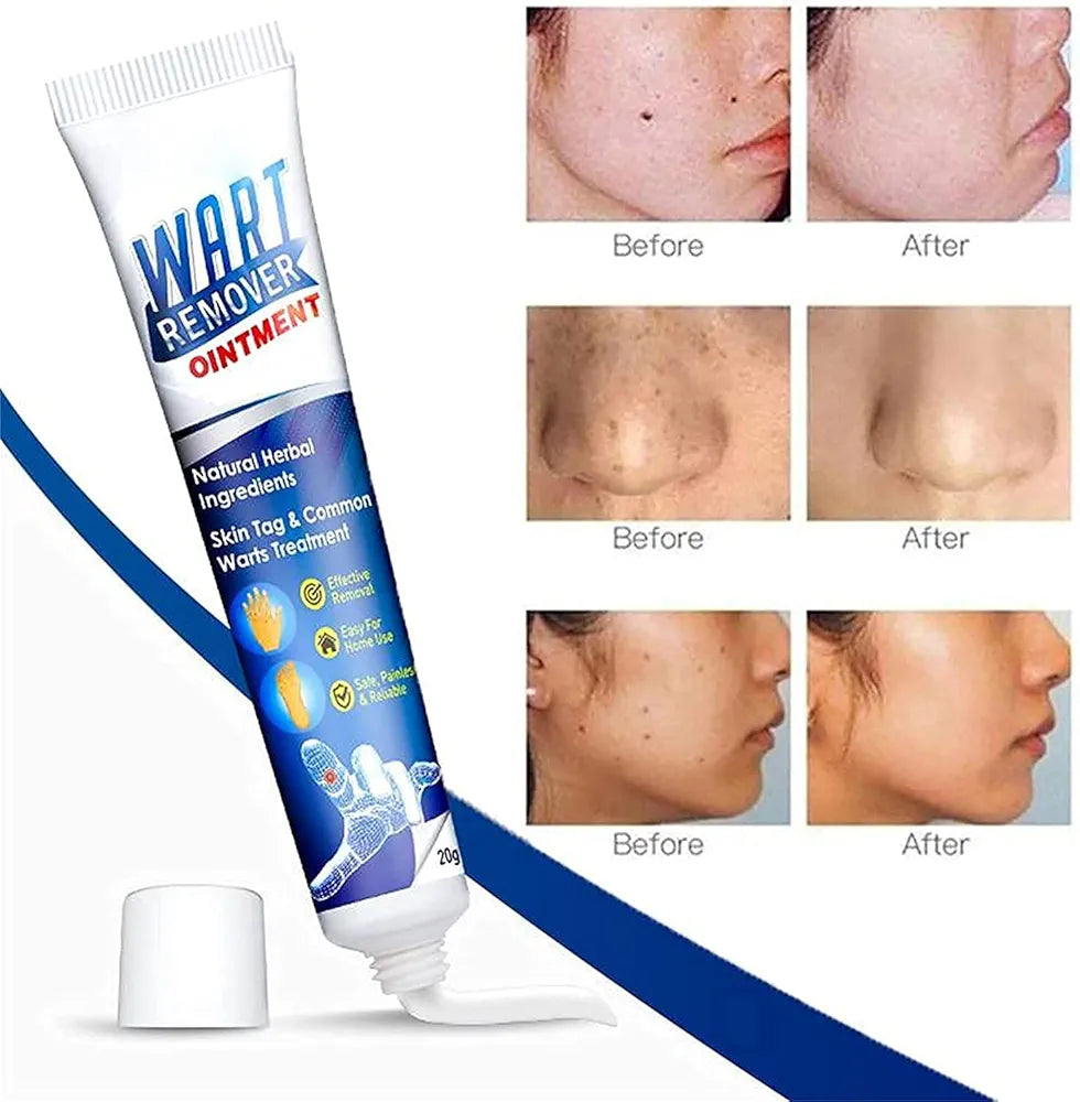 Wart Remover, Skin Tag Remover, Cream-Quickly and Easily Remove Common Skin Tag, Wart and Callus